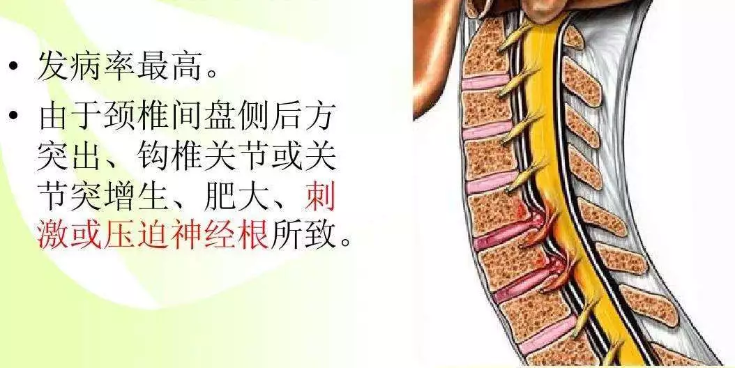 細(xì)說頸椎病的分型：六大頸椎病型你知道嗎？
